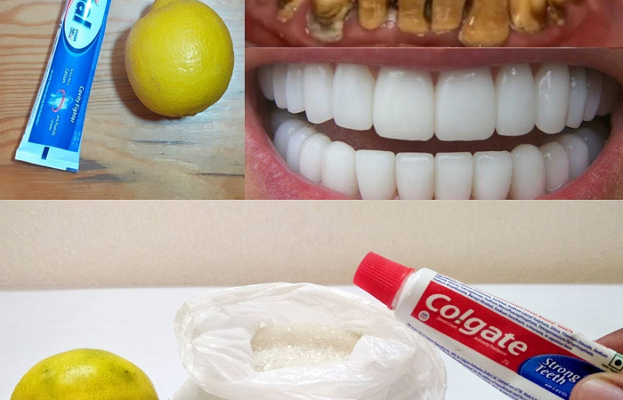 Natural Mixture for Yellow Teeth Whitening at Home in One Day Without a Dentist