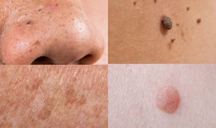 Eliminate Moles, Warts, Blackheads, Skin Tags, and Age Spots Naturally and Permanently