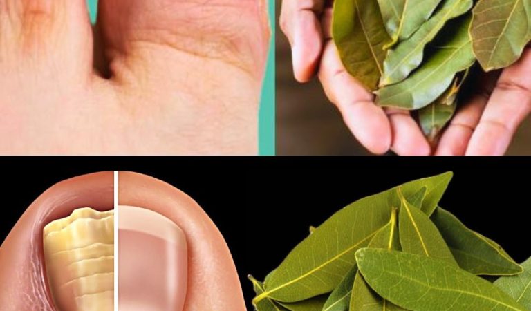 Eliminate Nail Fungus Naturally with Bay Leaves