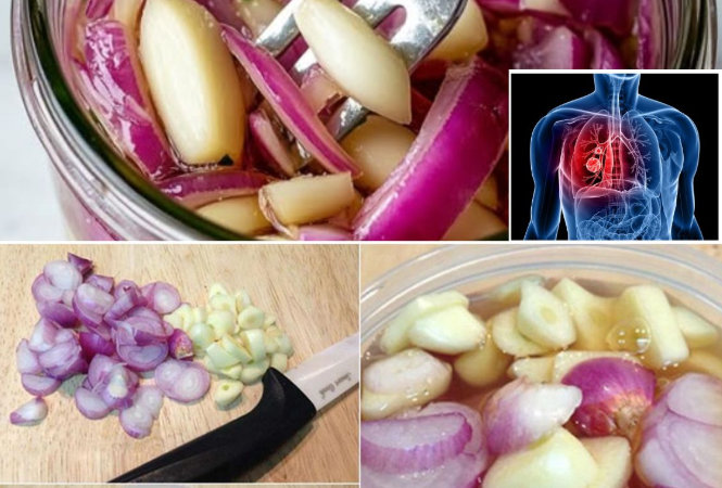 Recipe for Red Onion, Garlic, and Honey to Treat Lungs, Cough, and Colds