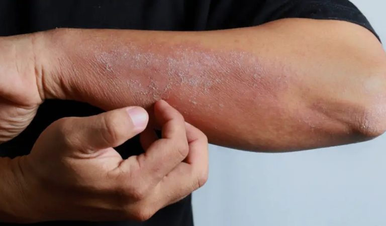 If you see these painful red bumps, you may have dyshidrotic eczema