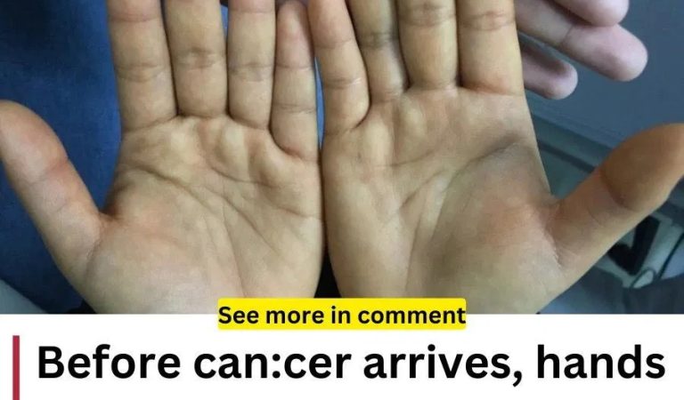 These 4 Symptoms Are Frequently Seen In Hands And Feet Before C-an-cer Develops