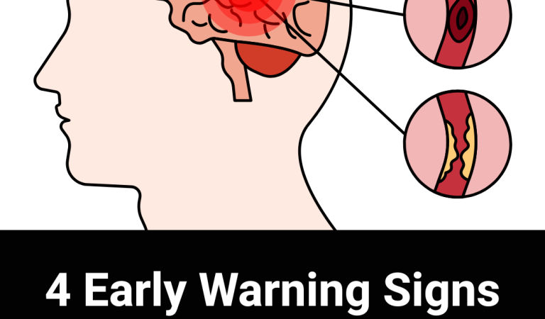 4 Early Warning Signs of Str0ke and How to Spot Them Fast