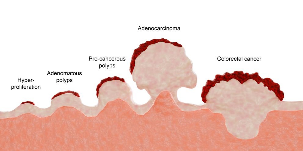 Illustration depicting the stages of colorectal cancer tumor development. The advanced stages, including adenocarcinoma, represent the transformation into a fully malignant condition | Source: Getty Images