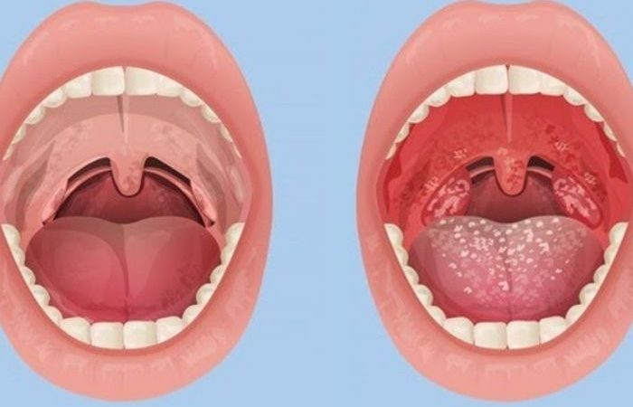 Home Remedies to Eliminate Bad Breath and Achieve a Fresher Mouth”